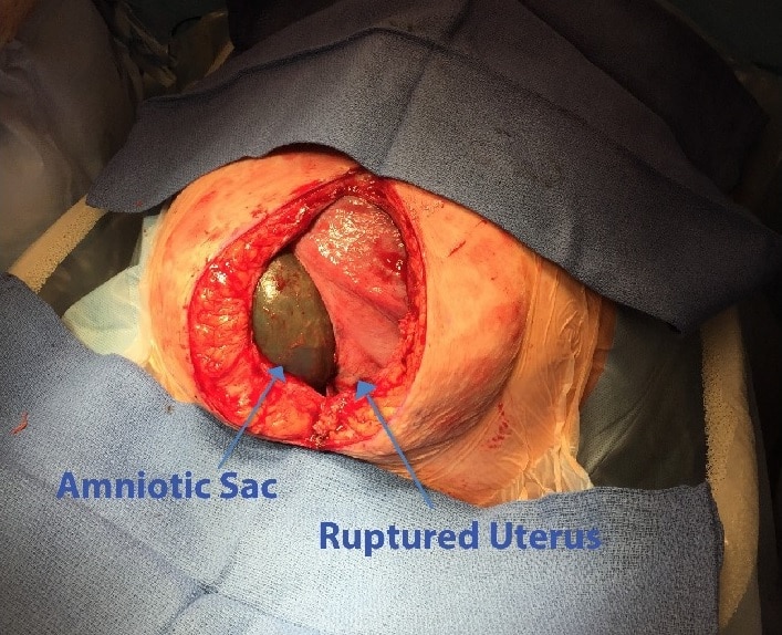 Fig 1 - Operative image of a complete uterine rupture. The amniotic sac is intact - this is unusual, as most cases of uterine rupture occur during labour.