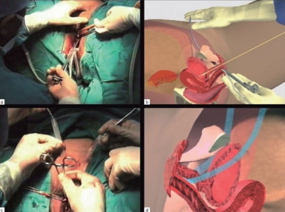 Urinary Incontinence - Stress - Urge - Management - TeachMeObGyn