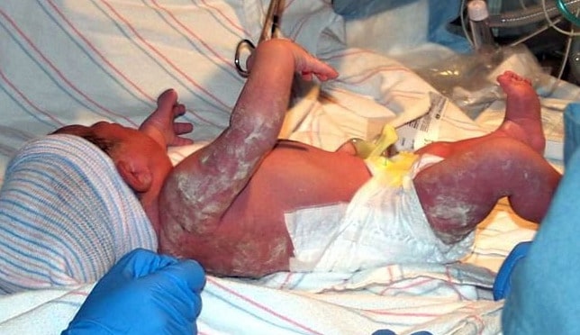 Fig 1 -Vernix on a newborn. Prolonged pregnancy babies are typically born with less vernix and drier skin.