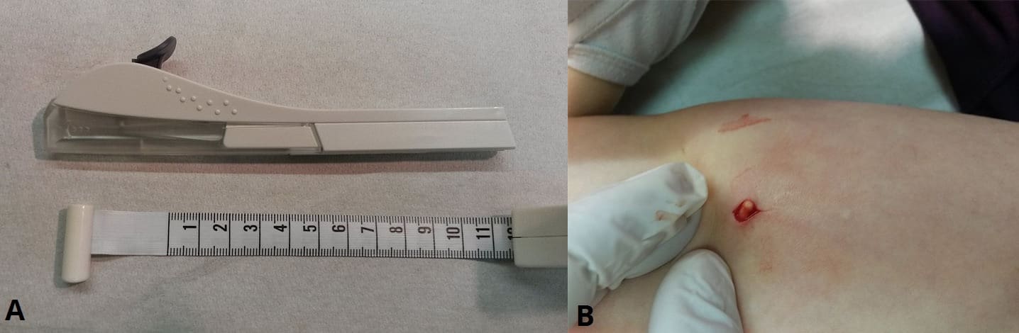 Implant Insert Contraceptive Implant - Procedure - Indications - Contraindications ...