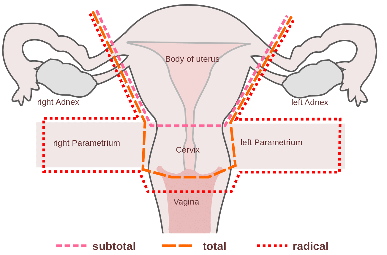 Hysterectomy Procedure Indications Complications Teachmeobgyn