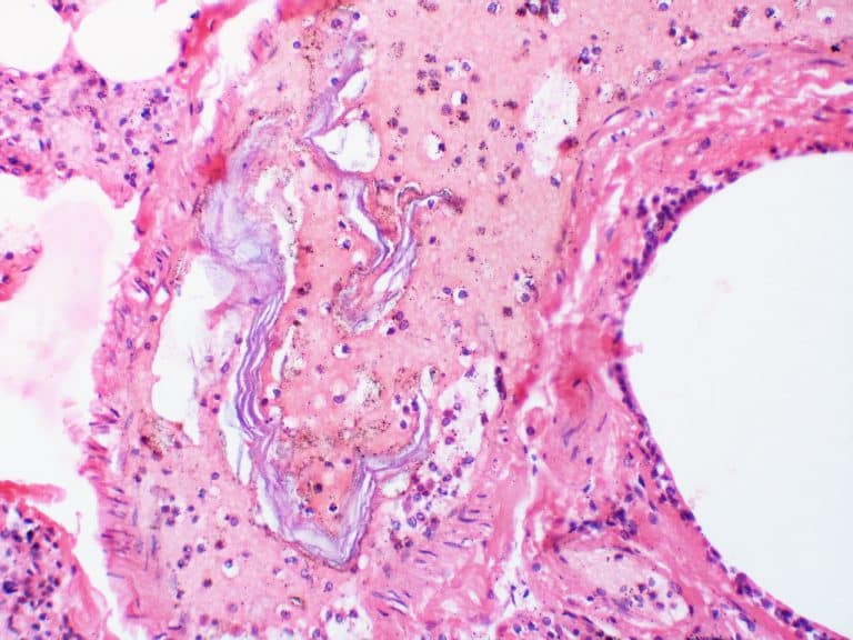 Amniotic Fluid Embolism Clinical Features Resuscitation TeachMeObGyn