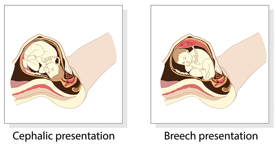 what are the presentation in pregnancy