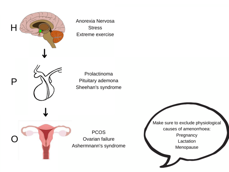 Amenorrhoea & Oligomenorrhoea - Causes - Investigations - TeachMeObGyn