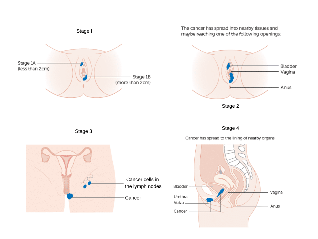 Stage 4 Vulvar Cancer: Definition, Treatment, and Survival Rates
