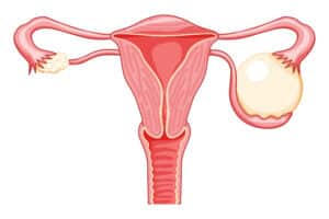 An ovarian cyst is a fluid-filled sac arising within the ovary