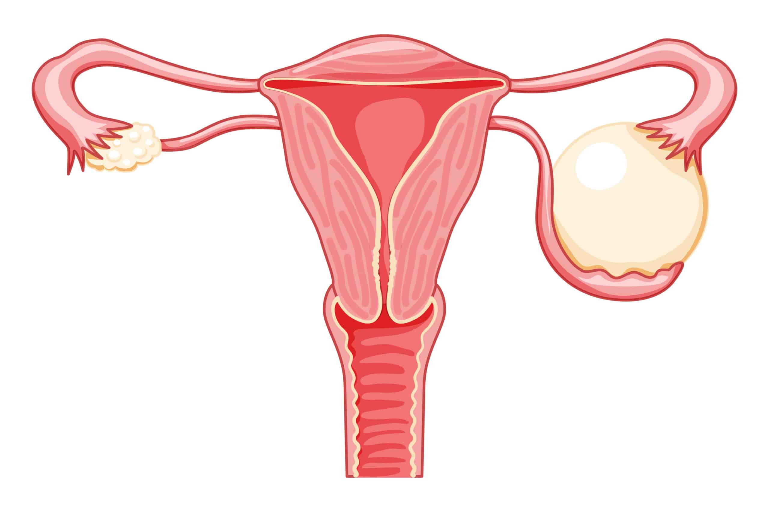 An ovarian cyst is a fluid-filled sac arising within the ovary